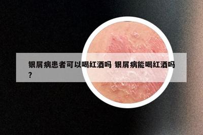 银屑病患者可以喝红酒吗 银屑病能喝红酒吗?