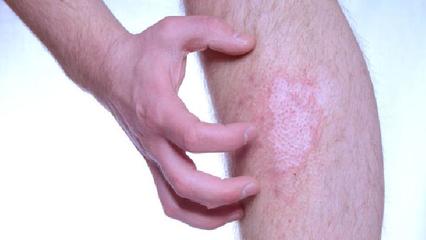 蜂产品治疗牛皮癣