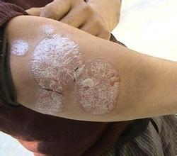 长春治疗牛皮癣的医院有哪些