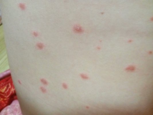 牛皮癣症状皮肤?