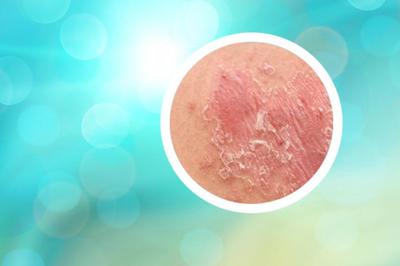 小孩起牛皮癣抹什么药