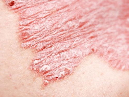 几块钱一瓶的甲硝唑,或能帮助摆平这4种病,你知道吗