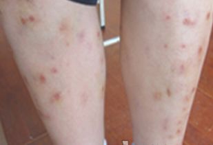 牛皮癣能治疗好吗