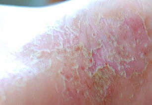 白酒泡花椒治牛皮癣吗