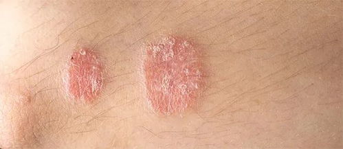 深圳肤康皮肤病专科 牛皮癣治疗原则及注意事项