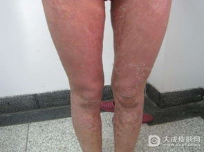 牛皮癣要怎么正确防护