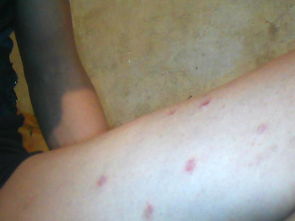 使用牛皮癣软膏应该注意哪些