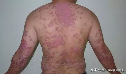 患了牛皮癣 吃这个食品,对牛皮癣的康复很有帮助