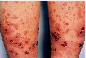 牛皮癣性血管炎症状