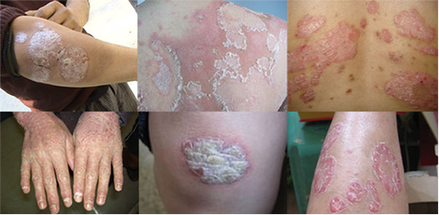 银屑病会传染?多半是误传