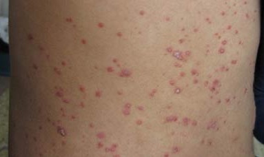 银屑病(牛皮癣)对身体的危害