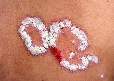 牛皮癣牛皮癣-什么是牛皮癣及图片