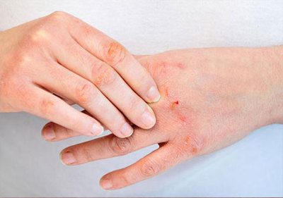 手足牛皮癣症状图片是什么样的及治疗