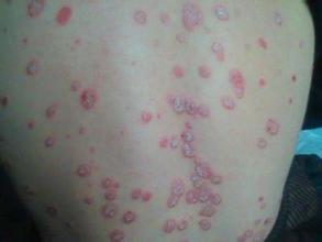 青年牛皮癣中医病因