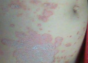 关于牛皮癣传染孕妇