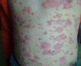 上海牛皮癣医院哪家最好