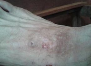 中年红皮病型牛皮癣运动