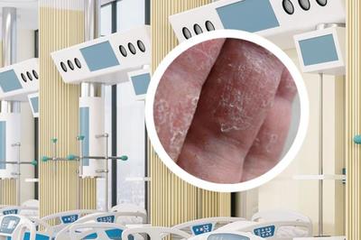 银屑病的正规治疗方法