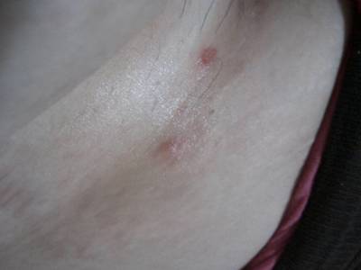 初期牛皮癣能冶好吗