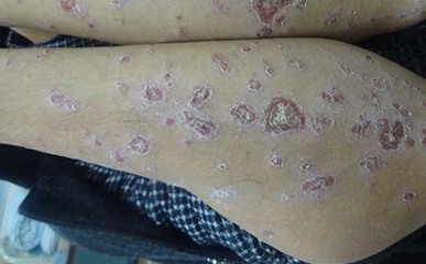 引发牛皮癣出现的因素是什么