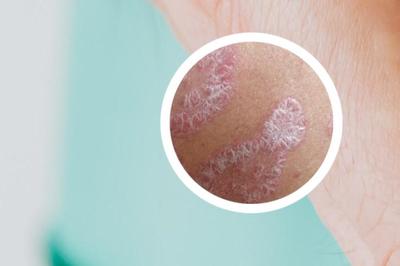 偏方根治银屑病