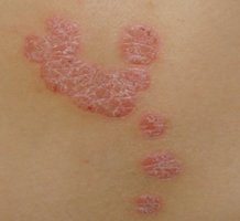 遗传引发牛皮癣吗