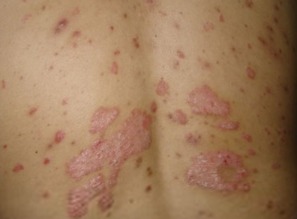 牛皮癣引起原因有哪些