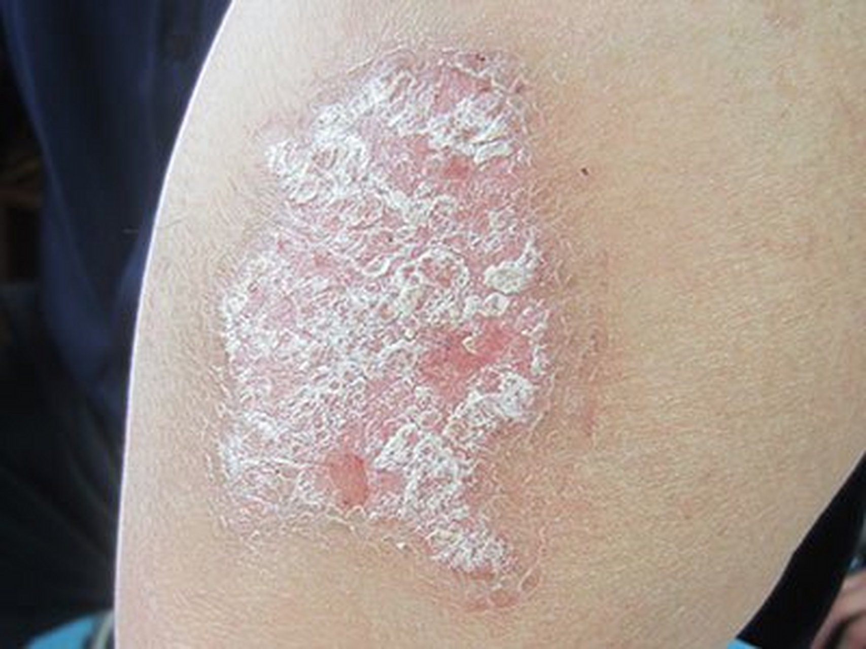 #皮肤病##头部银屑病# #牛皮癣# 银屑病传染吗? 银屑病可以发生在脸