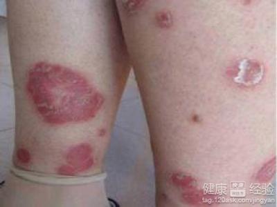 白疵就是牛皮癣吗