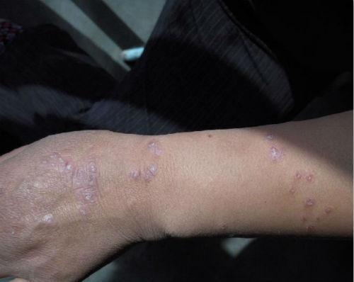 牛皮癣3种常用的药膏,用了不易复发,一人收藏,全家人不生癣