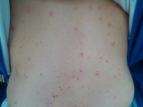 牛皮癣吃什么好一点呢