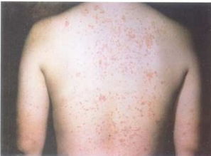 牛皮癣是什么样的