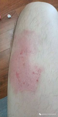 牛皮癣患者遇上美宝,从此不再痛苦烦恼