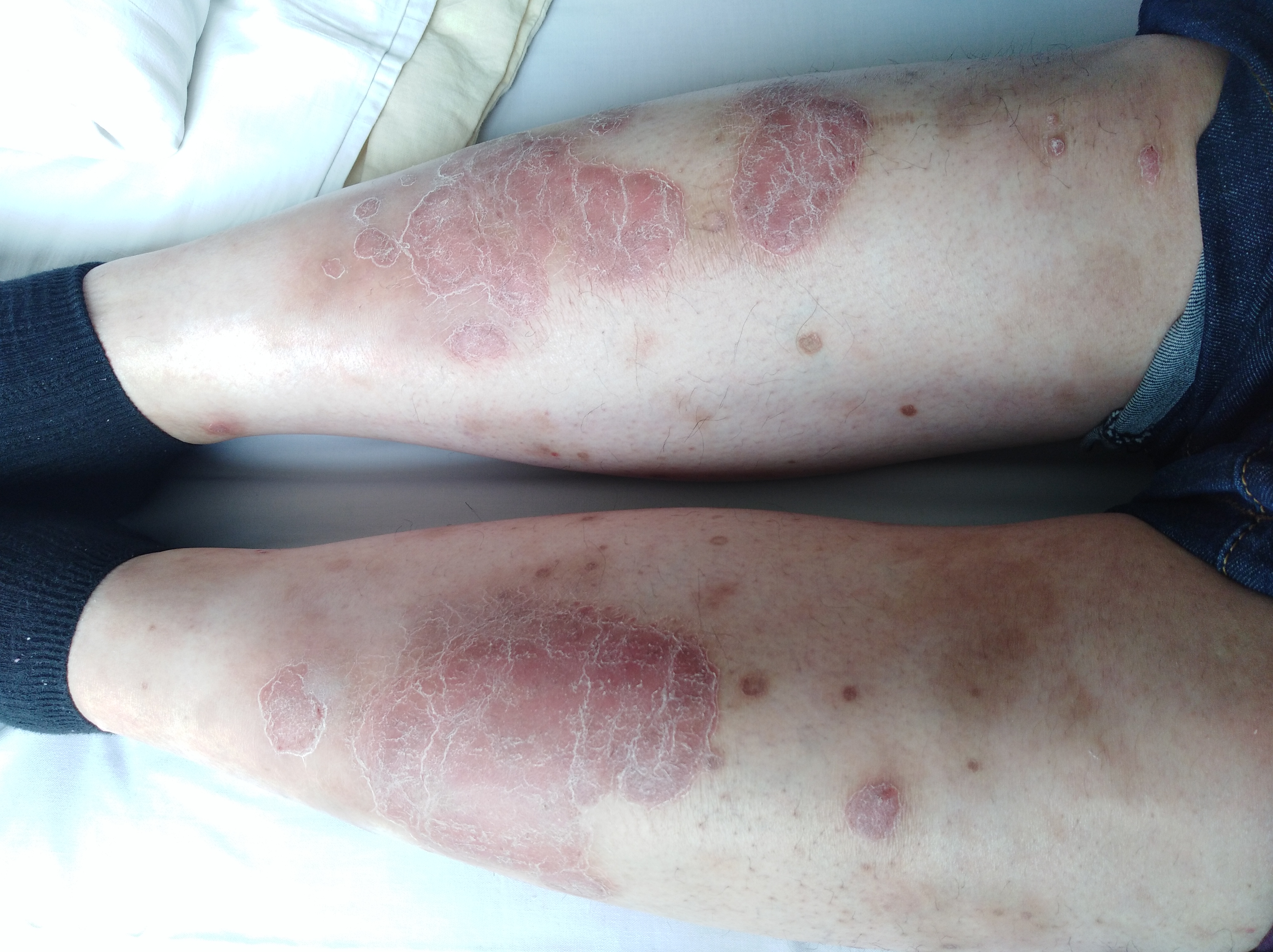 银屑病「牛皮癣」是真菌感染所致的「癣病」吗?-毛梦平执业医师-爱问