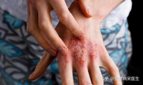 煤焦油 100多年来,一直用于银屑病治疗的外用药