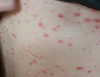 点状牛皮癣怎么治