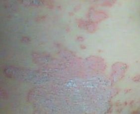 牛皮癣的人能吃海参吗