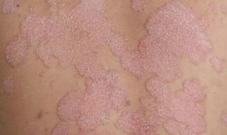牛皮癣 银屑病 患者注意,正确辨识,才能 过关斩将