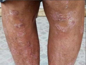 难治的牛皮癣,靠吃就能痊愈