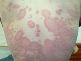 预防牛皮癣的四步攻略都有哪些