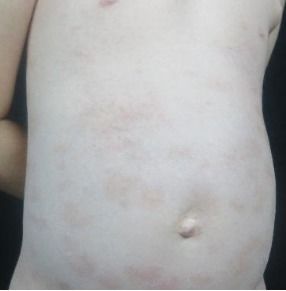 生物制剂治疗银屑病 司库奇优单抗 苏金 阿达木单抗 乌斯奴单抗 牛皮癣 生物治疗