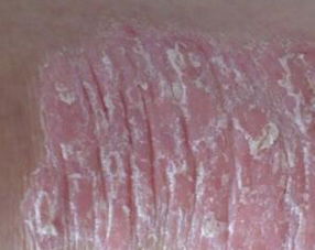 女性关节病型牛皮癣西医诊断