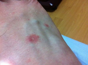 请看看是不玫瑰糠疹还是银屑病,或者同时都有 怎么脚上的这么严重