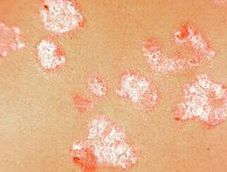 老年寻常型牛皮癣危害