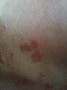 请专业皮肤人士帮我判定下我的皮肤到底是不是得了牛皮癣还是其他癣