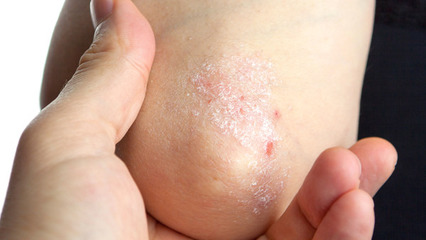 牛皮癣和银屑病是一样的吗?同一疾病