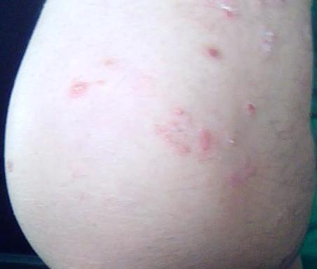 牛皮癣的早期症状图片