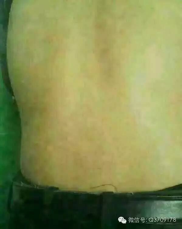 健康在转弯处等着您 完美产品见证 多年顽固的牛皮癣看不好,完美产品出奇效 超赞