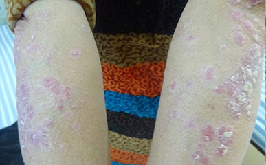 患者脱离牛皮癣 要这样做啊