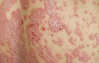 男性红皮病型牛皮癣寿命